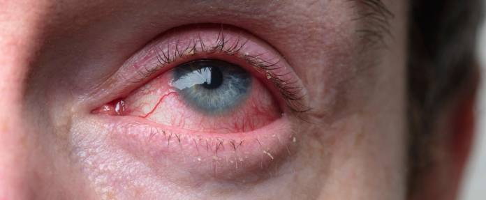 Mann mit rot gefärbten Augen und geschwollenen Augenlidern