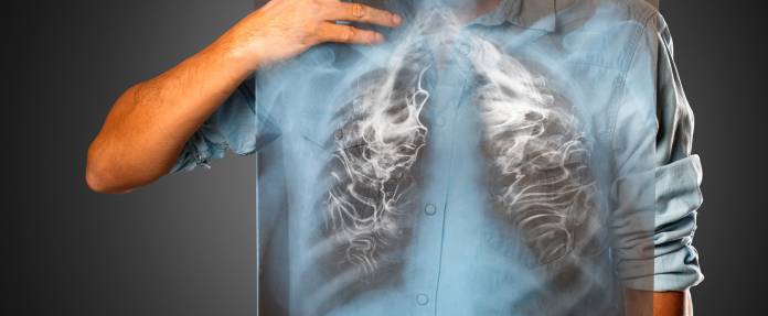 Chronisch-obstruktive Lungenerkrankung (COPD)