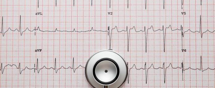 EKG, Elektrokardiogramm