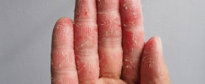 Dermatitis, Ekzem am Finger