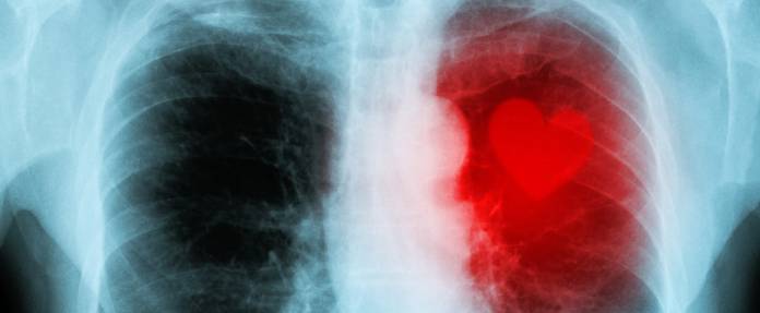 Röntgenbild von Herzerkrankung