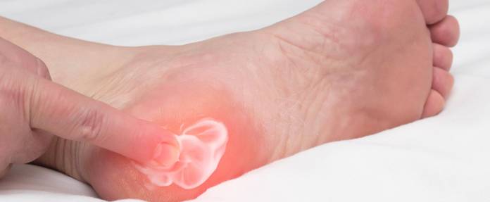 Schmerzende Ferse wird mit Salbe eingecremt