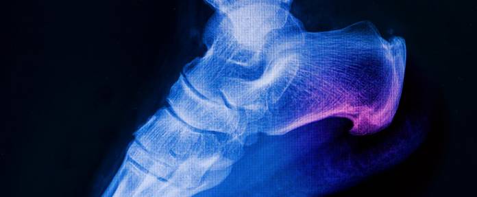 Röntgenbild eines Fersensporns