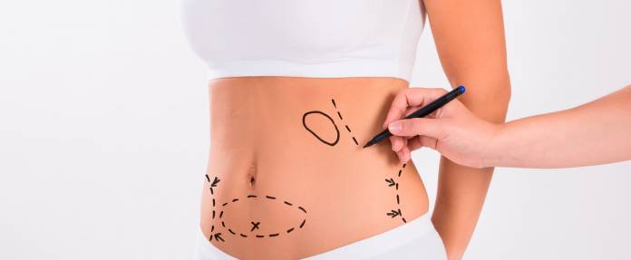 Fettabsaugung | Liposuktion (Liposuction) | Fett absaugen