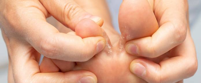 Frau schaut in die Zehenzwischenräume wegen Fußpilzbefall