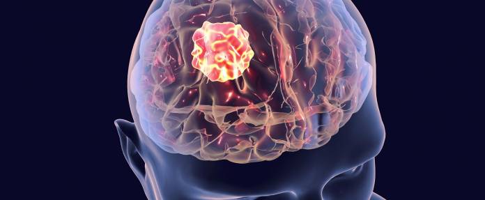 3D-Modell eines Kopfes mit Hirntumor