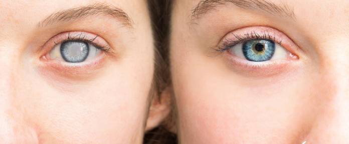 Zwei Frauen - eine Frau mit Linsentrübung, die andere mit gesunden Augen