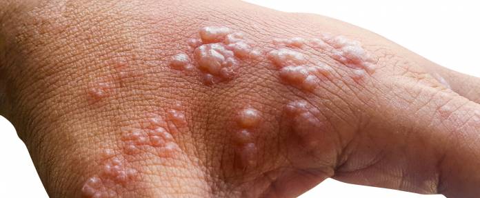 Gürtelrose an Hand und Fingern