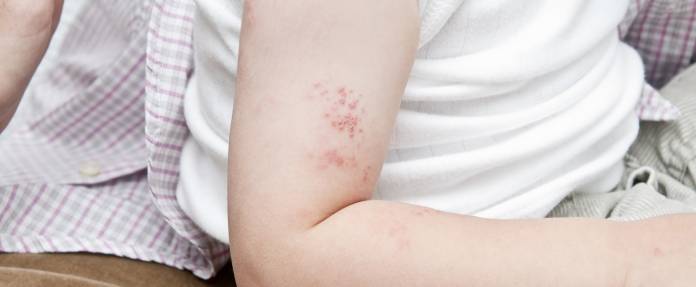 Hautausschlag auf dem Arm eines Kindes