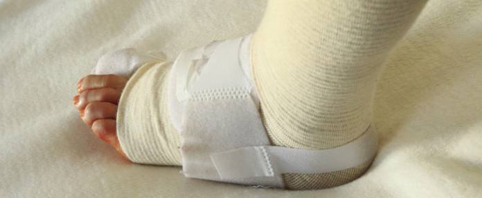 Fuß mit Bandage nach Hallux-valgus-Operation