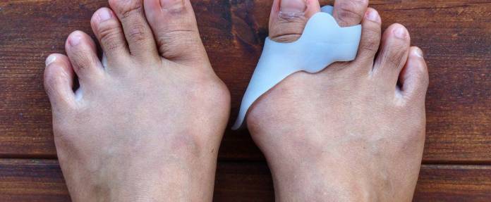 Zehenspreizer, Zehentrenner bei Hallux Valgus