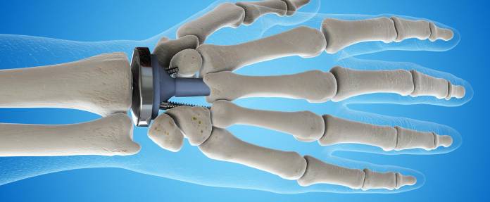 3D-Modell einer Handgelenksprothese