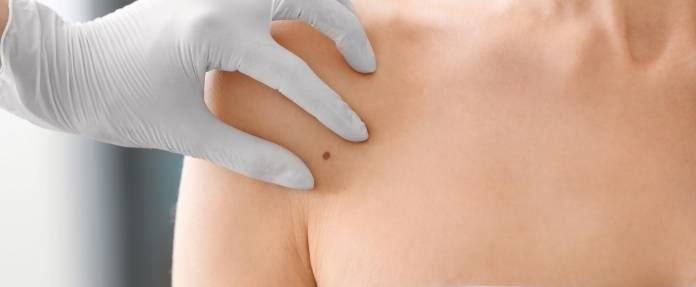 Dermatologe untersucht Muttermal auf Oberkörper einer Frau