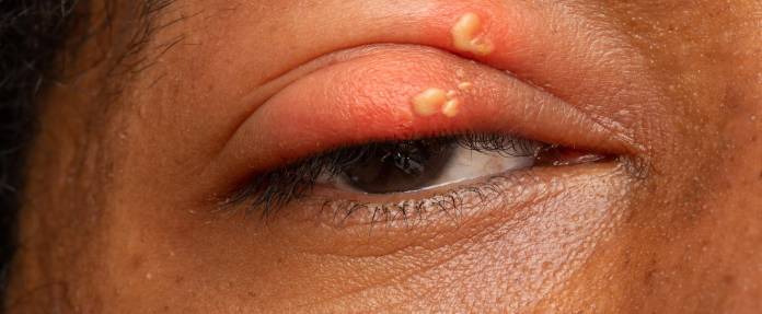 Mann mit Herpesbläschen am Augenlid