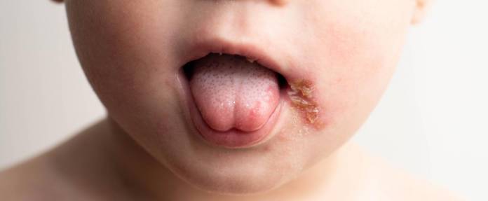 Kleinkind mit Herpes am und im Mund