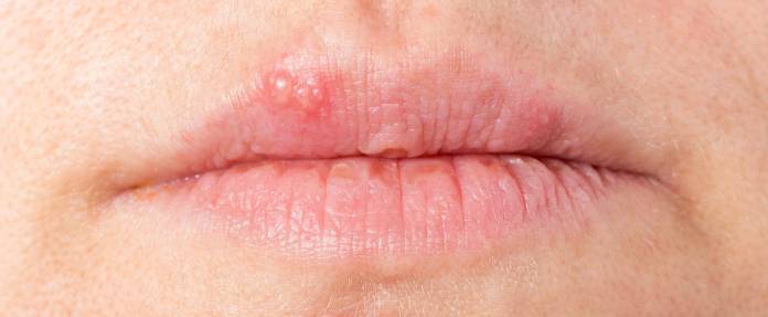 Frau mit Lippenherpes
