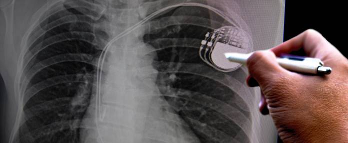 Arzt zeigt auf Herzschrittmacher auf Röntgenbild