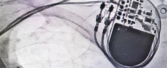 Röntgenbild mit einem Herzschrittmacher