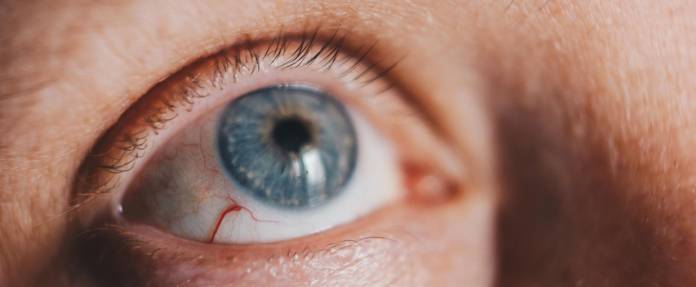 Entzündete Blutgefäße im Auge wie bei einer Hornhautentzündung
