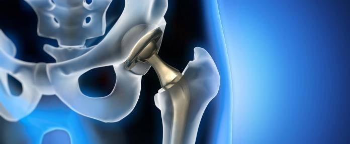 3D-Modell eines künstlichen Hüftgelenks