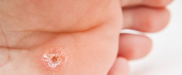 Warze an der Fußunterseite