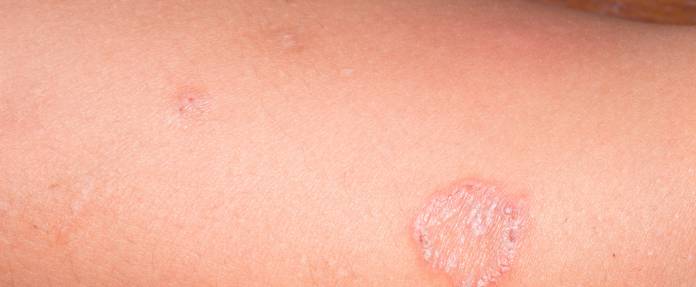 Impetigo contagiosa