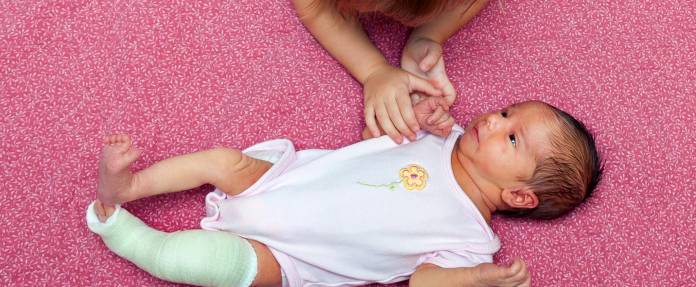 Klumpfuß-Behandlung bei Neugeborenem
