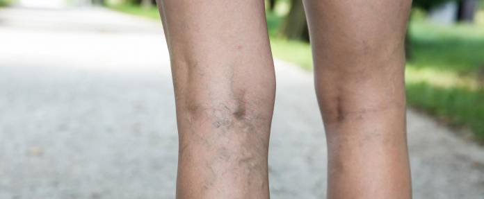 Beine mit erkennbaren Krampfadern auf der Rückseite