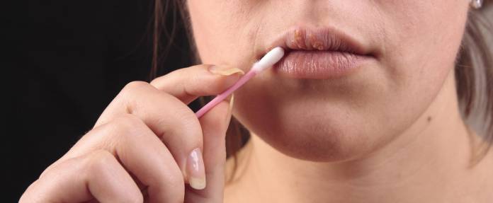 Junge Frau behandelt Lippenherpes mit Wattestäbchen