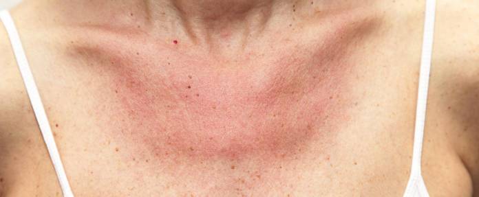 Frau mit Sonnenbrand und allergischer Hautreaktion auf Dekollete