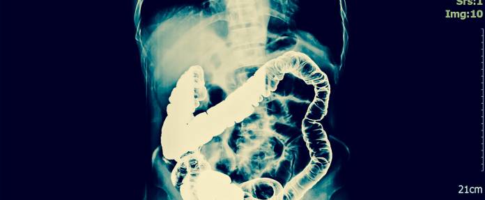 Röntgenaufnahme zeigt Abdomen im Bauchraum