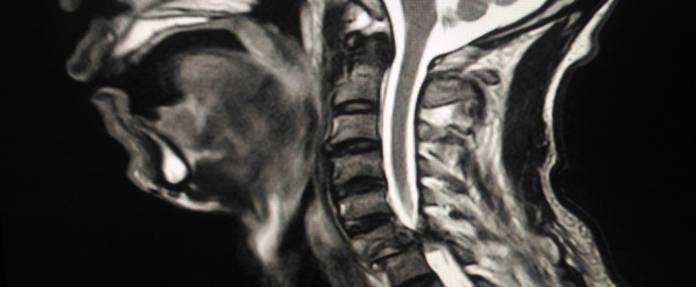 MRT der Halswirbelsäule zeigt Myelopathie