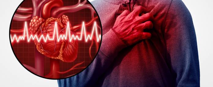 Herzinfarkt mit EKG