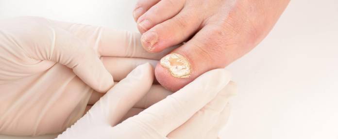 Arzt mit Handschuhen untersucht Nagelpilz an den Fußnägeln
