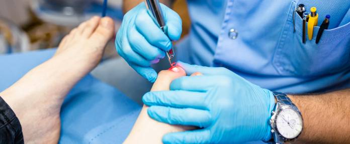 Nagelpilzbehandlung mit einem Laser