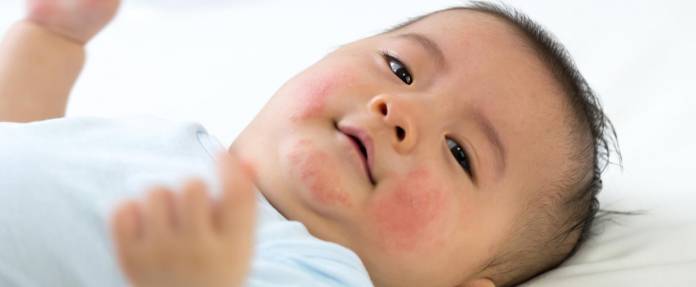 Nesselsucht bei einem Baby