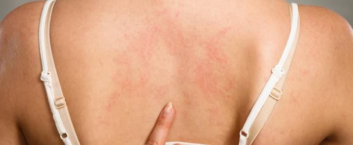 Frau zeigt auf Ausschlag, den Sie auf dem Rücken hat