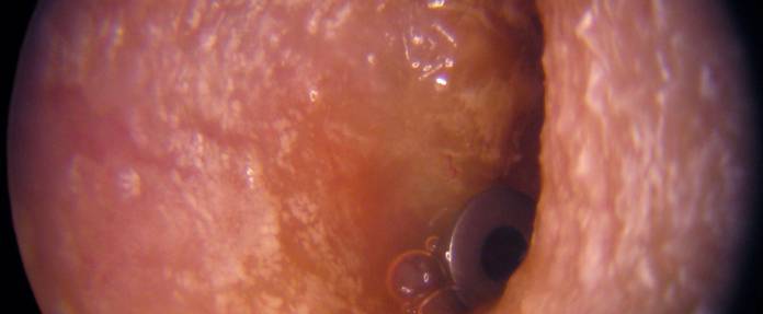 Paukenröhrchen bei chronischem Paukenerguss