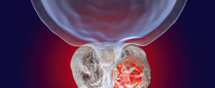 3D-Bild Prostatakrebs