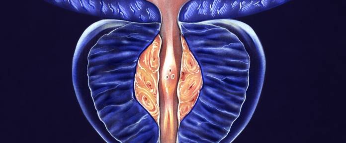 3D Darstellung einer vergrößerten Prostata