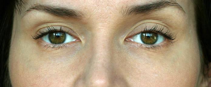 Hängendes Oberlid bei einer Frau (Ptosis)