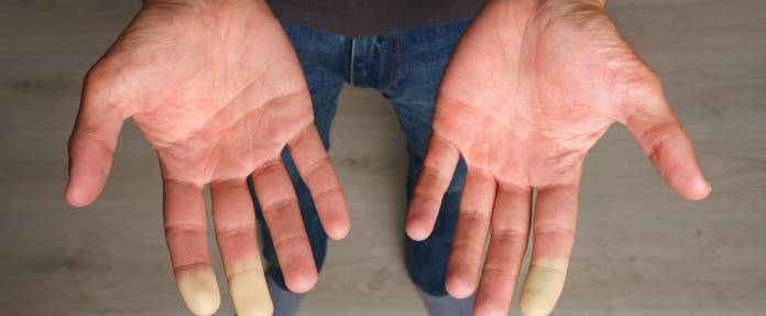 Mann mit weißgefärbten Fingern (Raynaud-Syndrom)