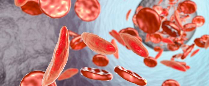 Sichelzellanämie, 3D-Abbildung von roten Blutkörperchen