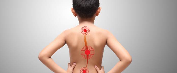 Junge mit Rückenverkrümmung (rot eingezeichnete gekrümmte Wirbelsäule)