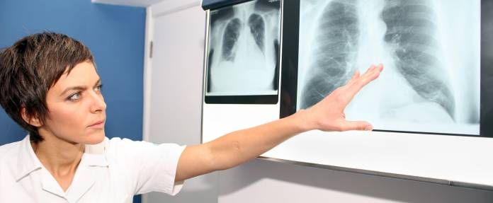 Ärztin zeigt auf Röntgenaufnahme der Lunge