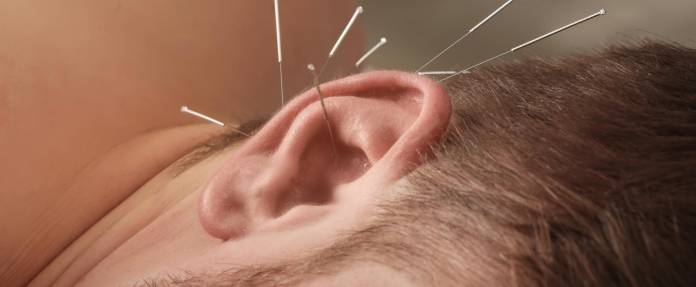 Mann mit Akupunkturnadeln im Ohr