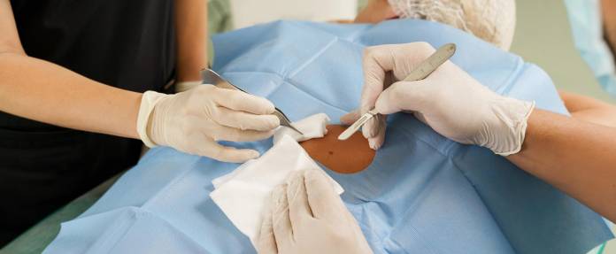 Entfernung eines Muttermals mit Skalpell