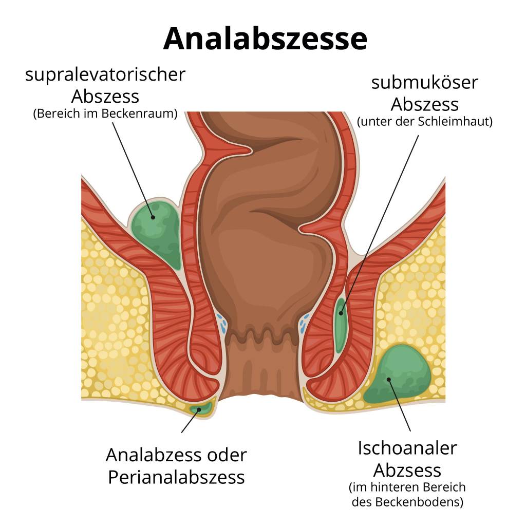 Steißbein abszess am Zahnentzündung: Pulpitis,