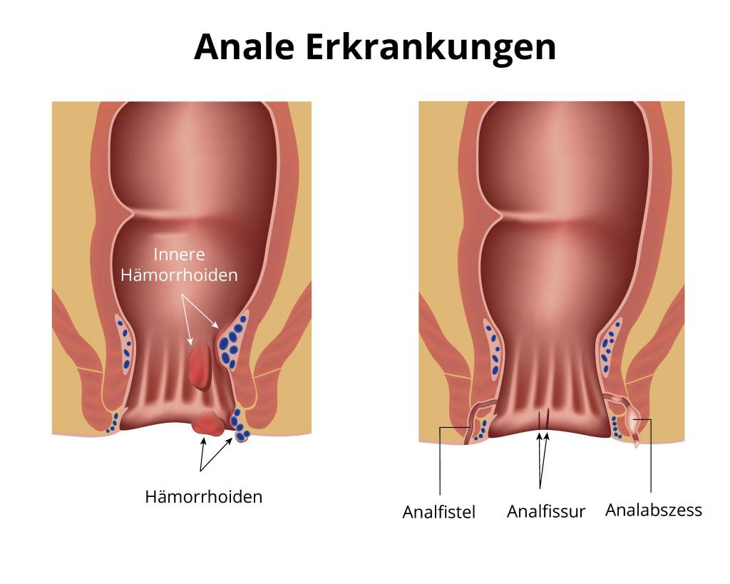 Am steißbein knoten Steissbein