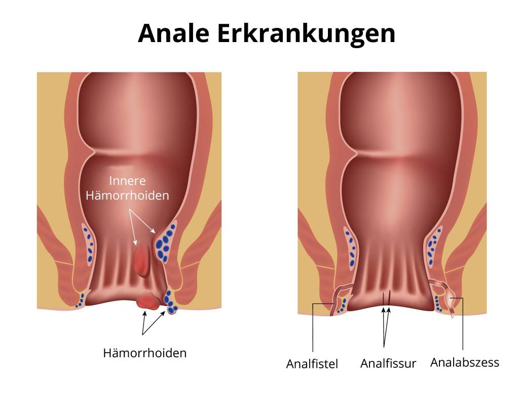 Geplatzt perianalthrombose Analvenenthrombose Blutung